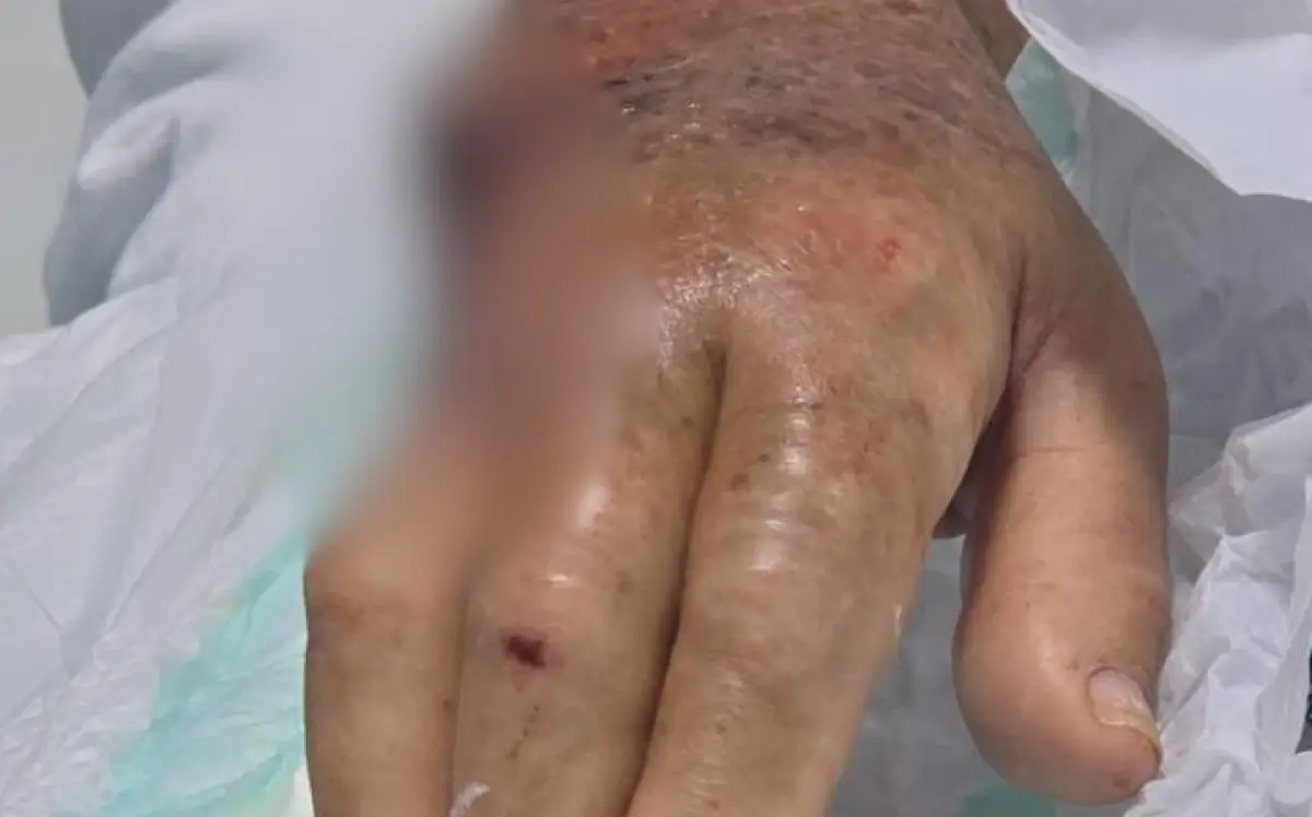 Idosa teve dedo mínimo e parte da mão esquerda amputados após ataque de cachorro
