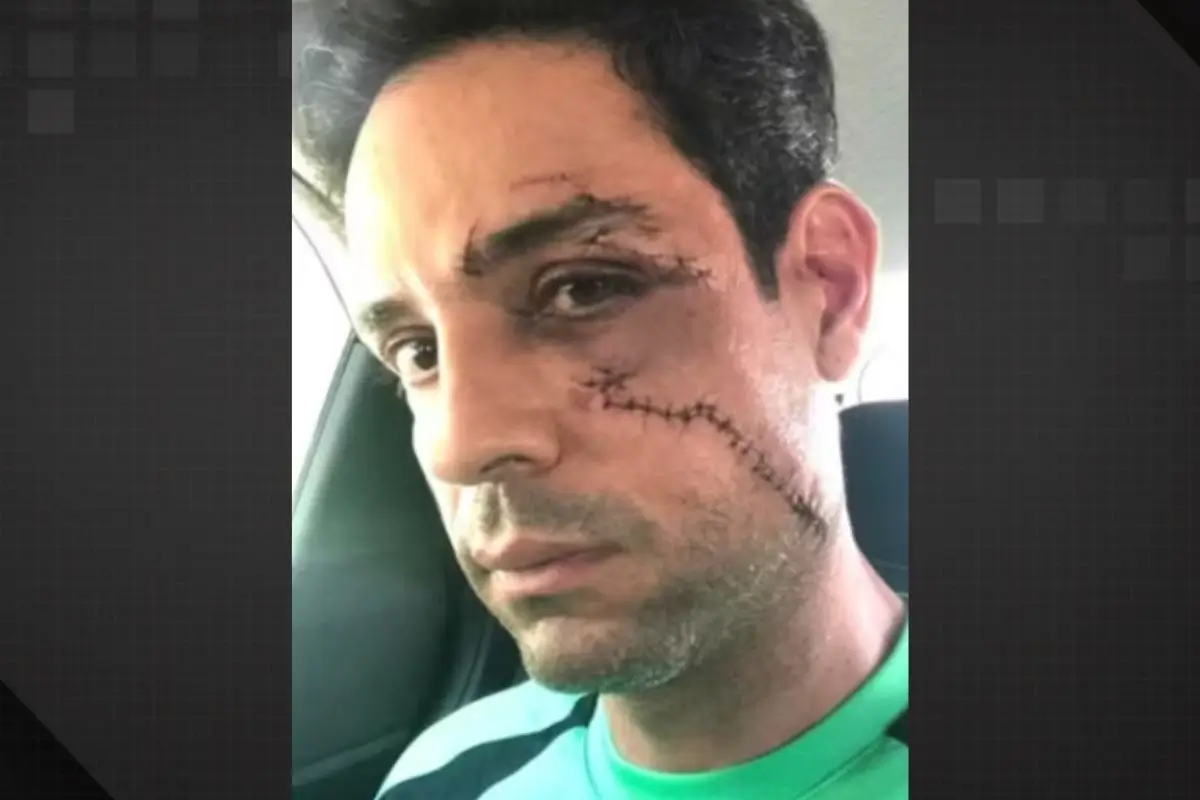 Empresário leva 62 pontos após agressão com copo de vidro