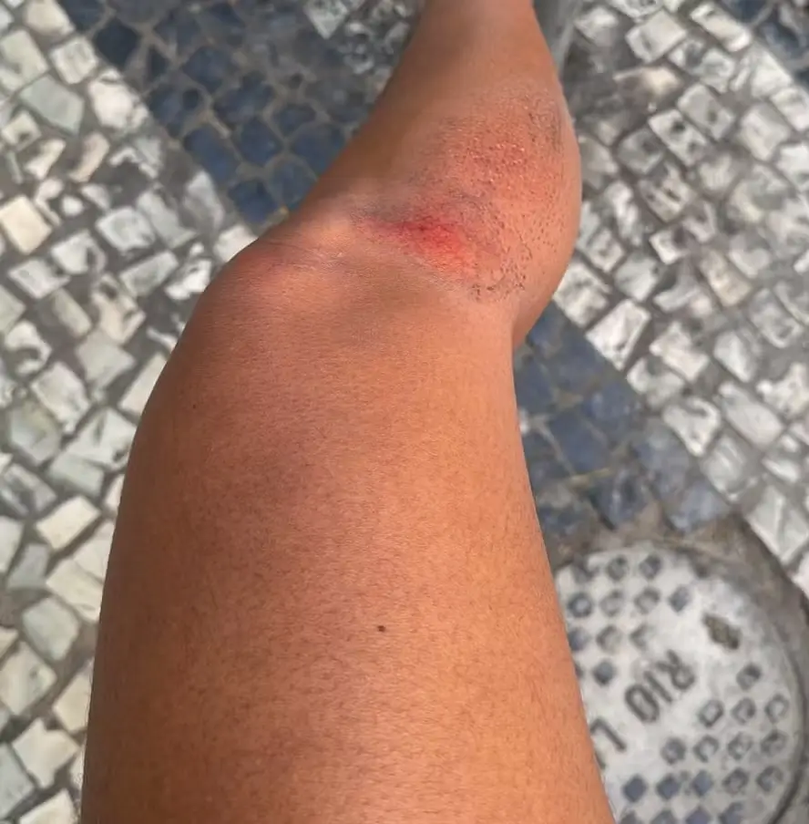 Pneu de Van atropelou perna