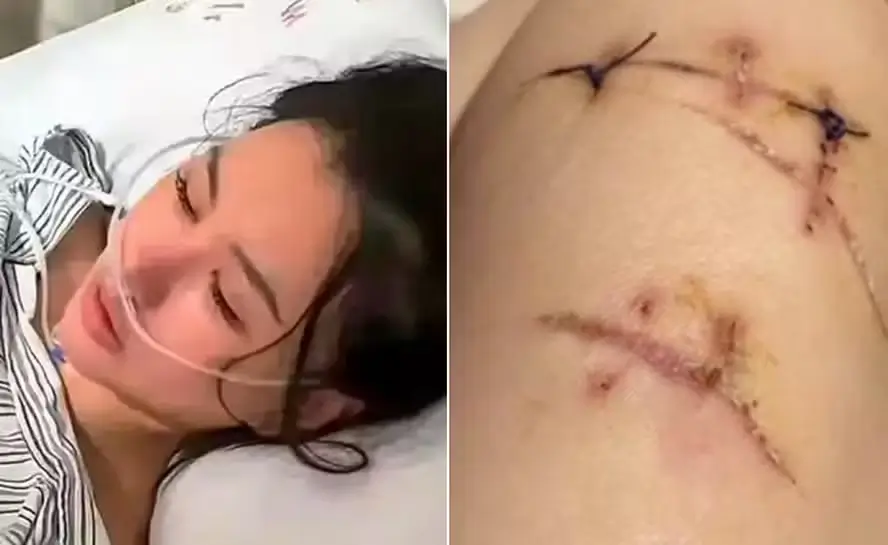 Seios de silicone salvam mulher esfaqueada 22 vezes na China