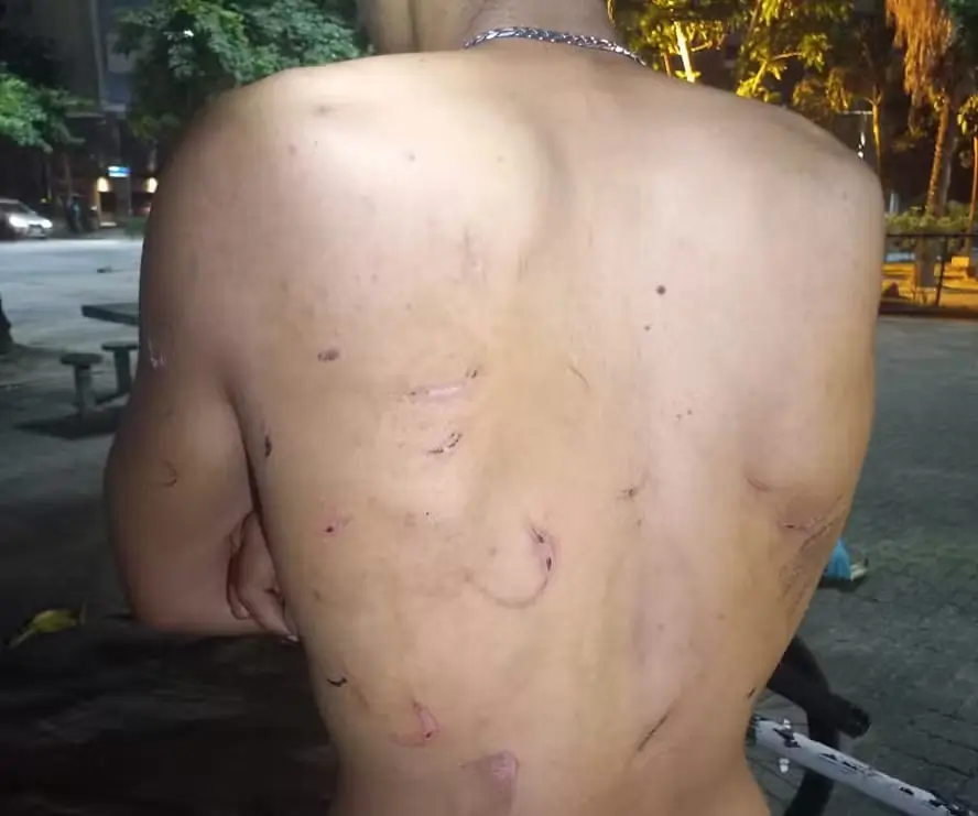 Marcas de agressão nas costas