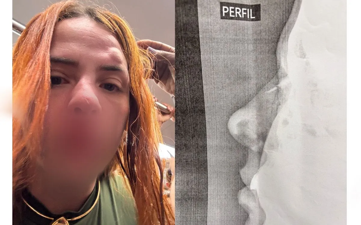 Karinny Gonçalves, relatou que foi espancada e teve o nariz fraturado
