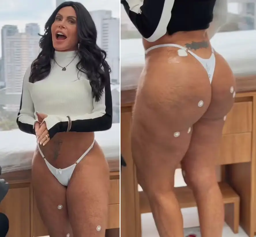 Gretchen faz manutenção estética no bumbum com PMMA