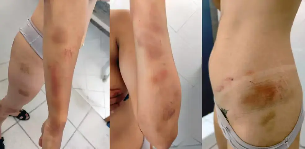 A estudante de enfermagem ficou com vários hematomas