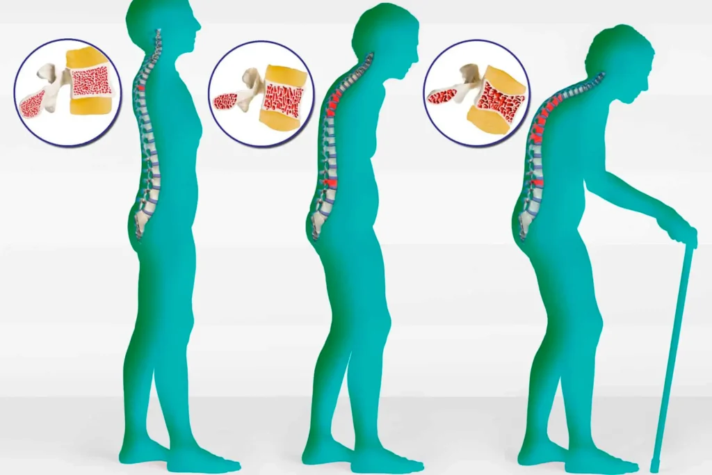 Osteoporose