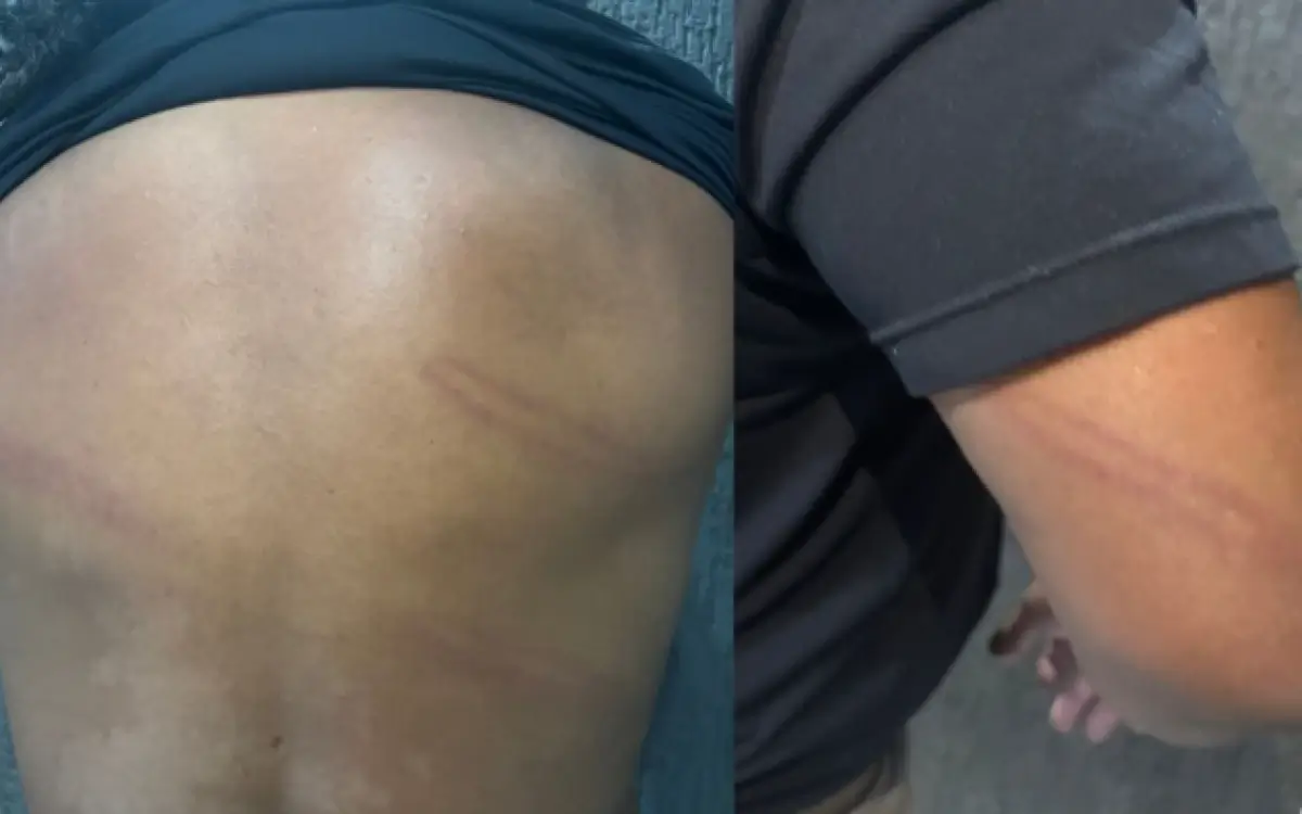 Perdigão compartilhou fotos de machucados