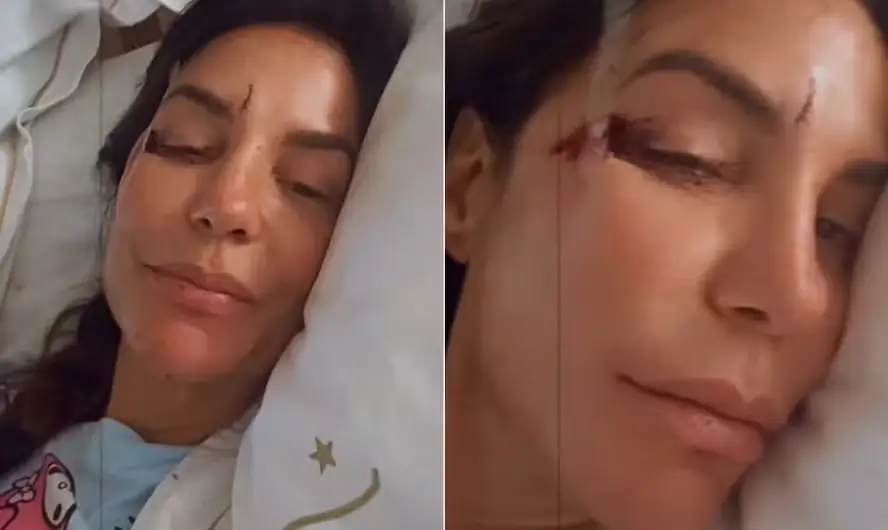 Ivete Sangalo sofre acidente em casa e aparece com olho roxo