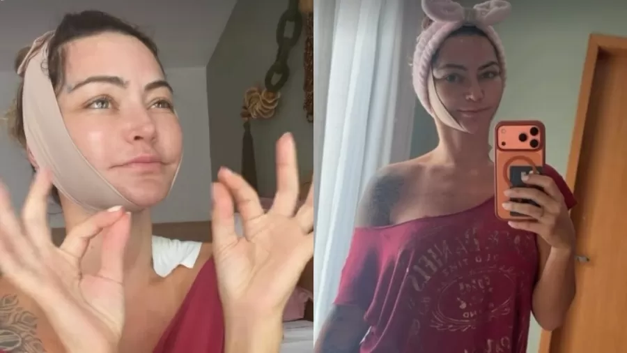 Laura Keller após lifting facial