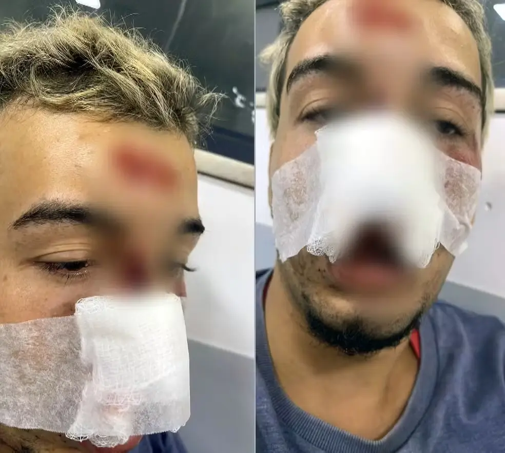 Erick sofreu cortes no rosto e perdeu dentes