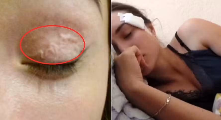 Parasita no rosto